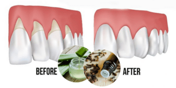 Grow Back Your Receding Gums With These Remedies